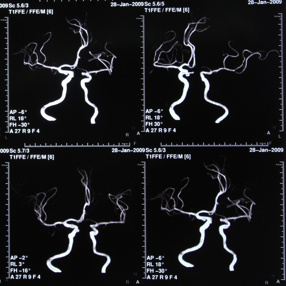 Intracranial MRA images collage